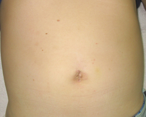 単孔式腹腔鏡下虫垂切除術の術後2週間目の腹部写真
