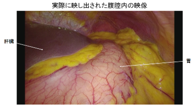 腹腔内