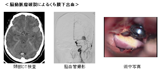 急性期および慢性期脳血管障害1