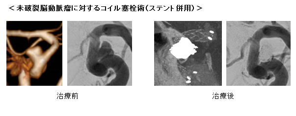 急性期および慢性期脳血管障害2