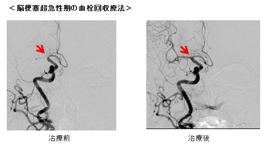 急性期および慢性期脳血管障害3