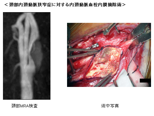 急性期および慢性期脳血管障害4