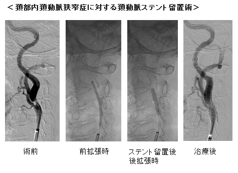 急性期および慢性期脳血管障害5