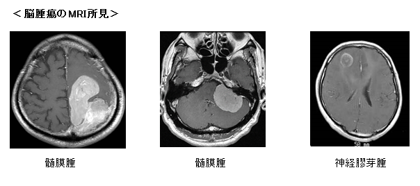 急性期および慢性期脳血管障害6