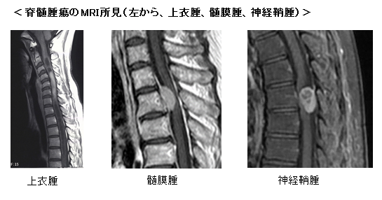 急性期および慢性期脳血管障害6