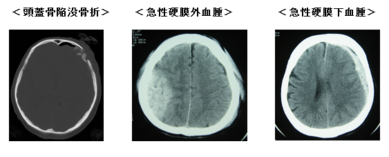 急性期および慢性期脳血管障害6