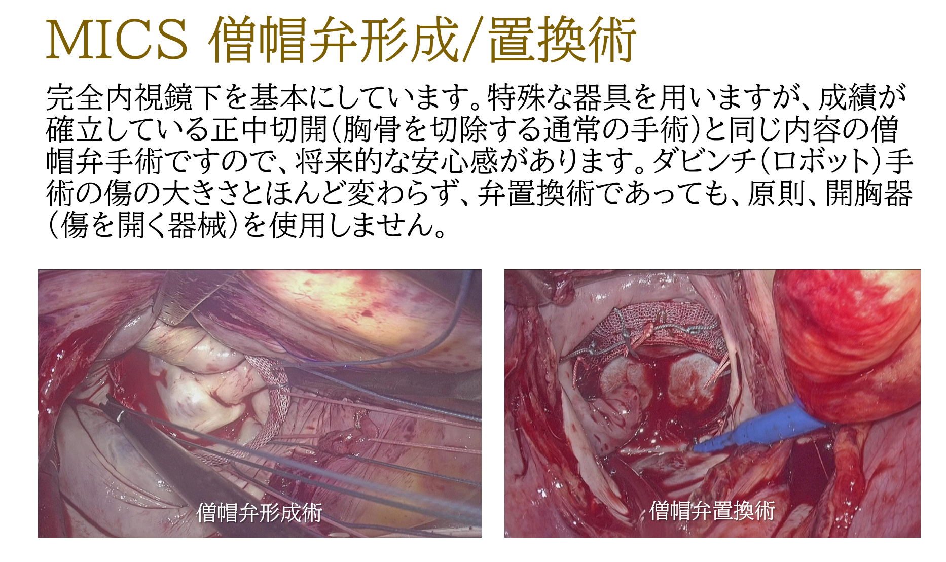 MICS 僧帽弁形成・置換術 