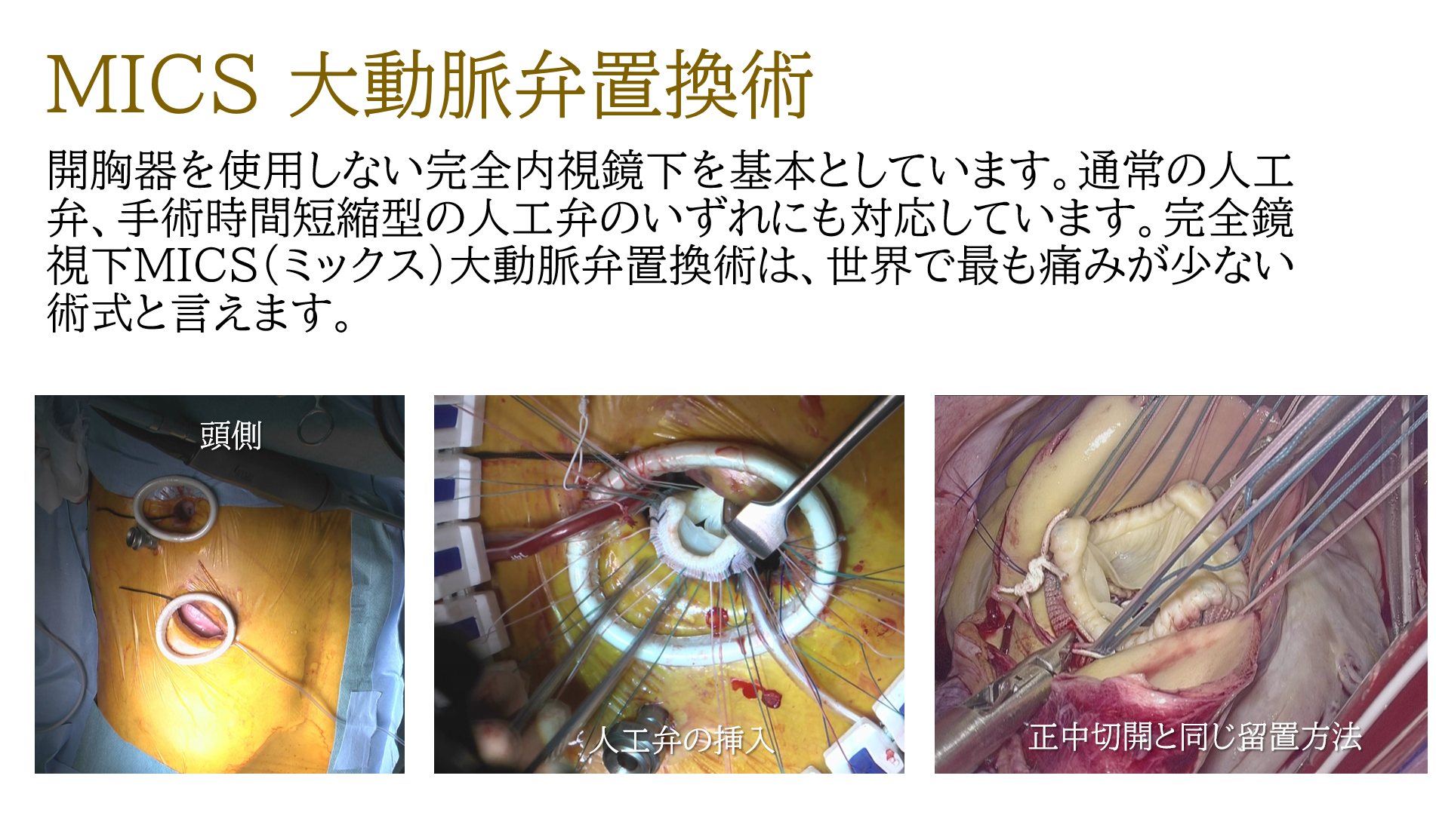 MICS 大動脈弁置換術
