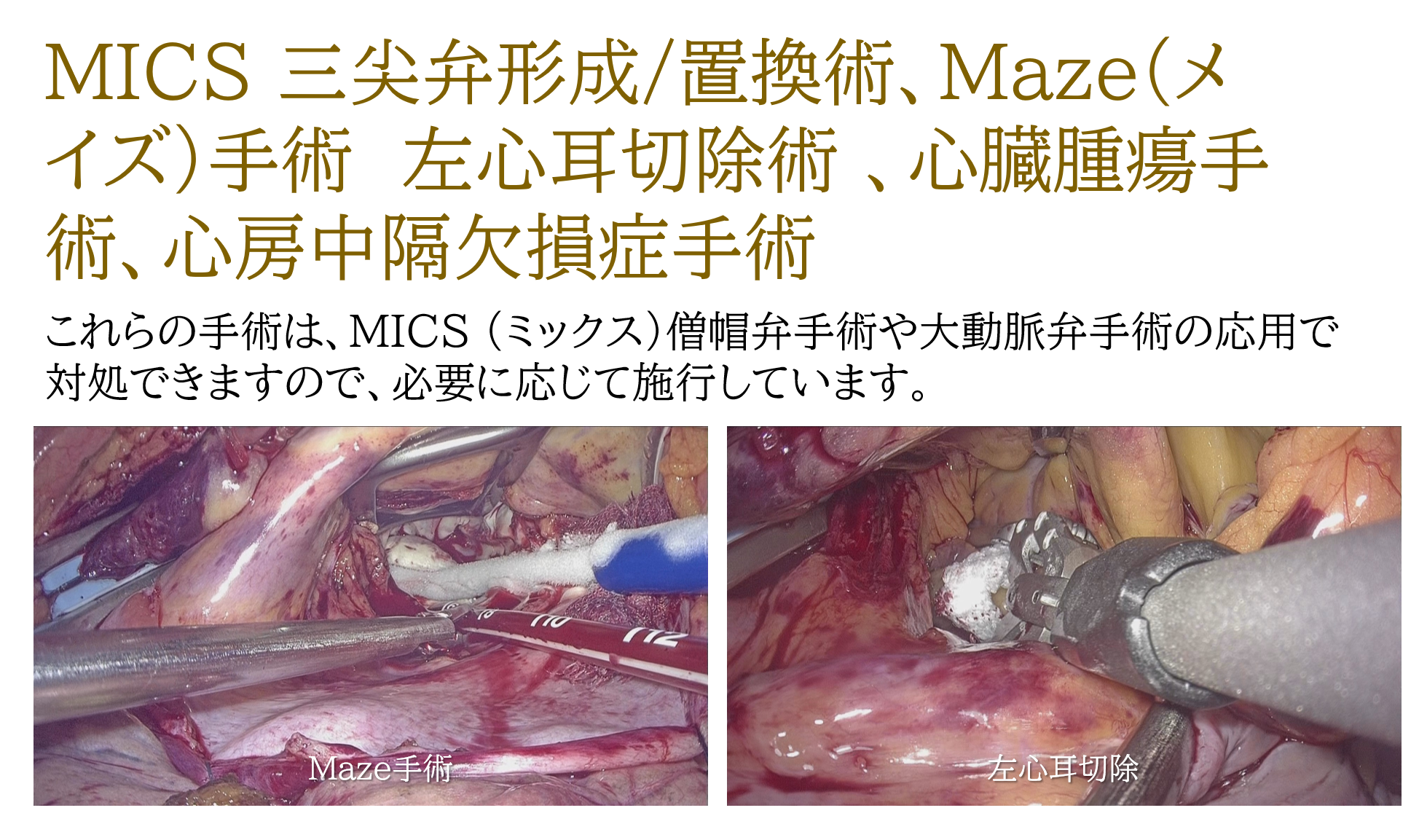 MICS 三尖弁形成・置換術他 